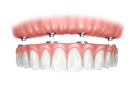 Interventi di Implantologia Dentale